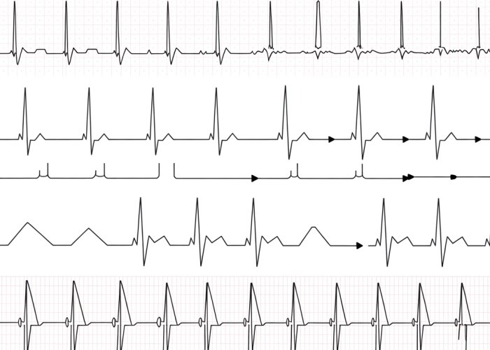 EKG strips showing common heart arrhythmias like atrial fibrillation, ventricular tachycardia, and sinus bradycardia. Practice your EKG interpretation skills.